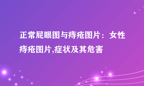 正常屁眼图与痔疮图片：女性痔疮图片,症状及其危害