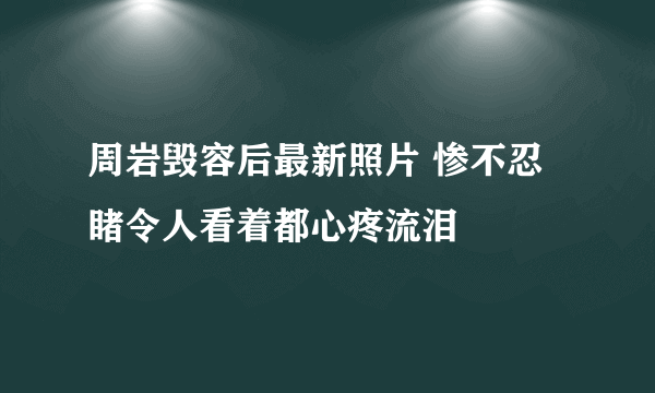 周岩毁容后最新照片 惨不忍睹令人看着都心疼流泪