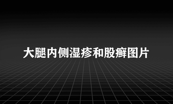 大腿内侧湿疹和股癣图片