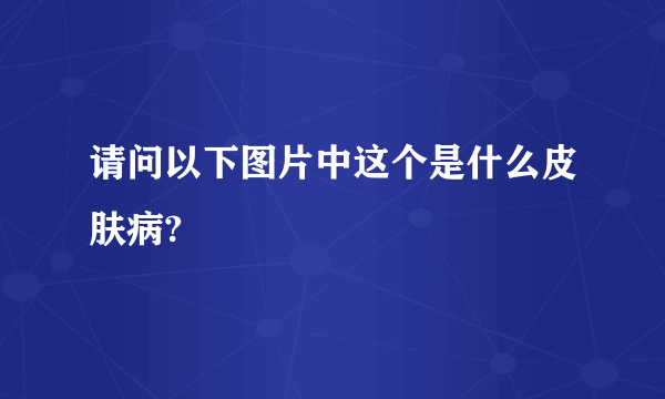 请问以下图片中这个是什么皮肤病?