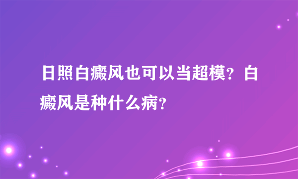 日照白癜风也可以当超模？白癜风是种什么病？