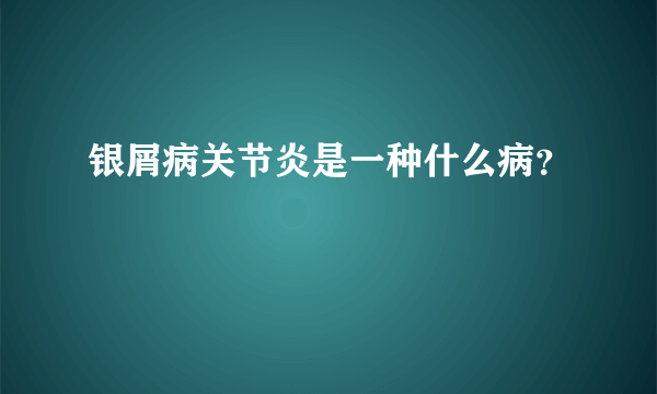 银屑病关节炎是一种什么病？