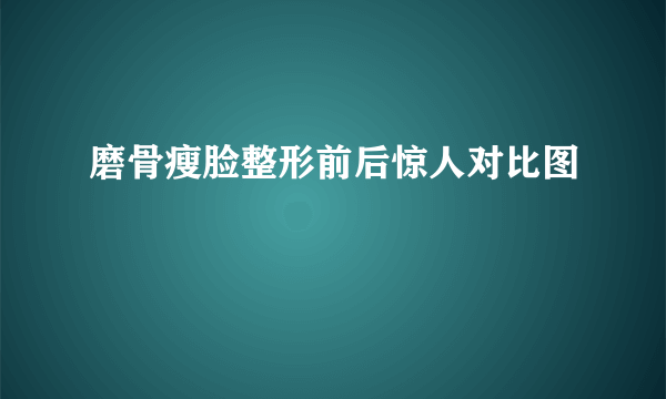 磨骨瘦脸整形前后惊人对比图